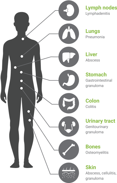 Infographic showing Chronic Granulomatous Disease affecting many body organs, including the lymph nodes, lungs, liver, stomach, colon, urinary tract, bones, and skin